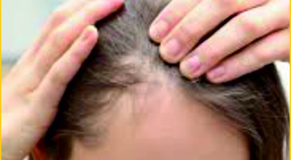 5-Alopecia Areata Treatment