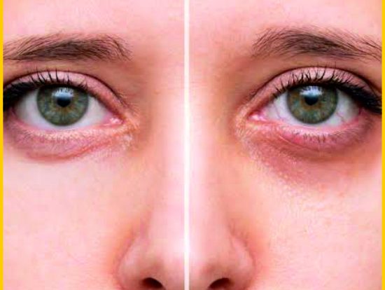 27-Under Eye Dark Circles Treatment 27-Under Eye Dark Circles Treatment