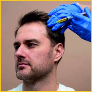 Hair prp treatment