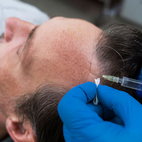 best chemical peeling