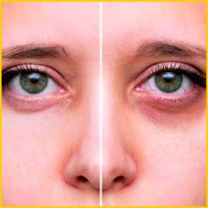 Best under eye dark circles treatment