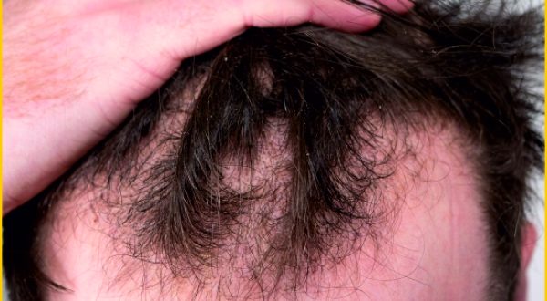 Male Hair loss treatment