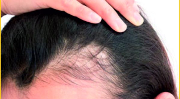 Female Hair loss treatment
