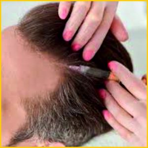 IPRF Hair Treatment