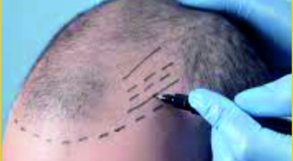 Painless hair transplant in gurgaon