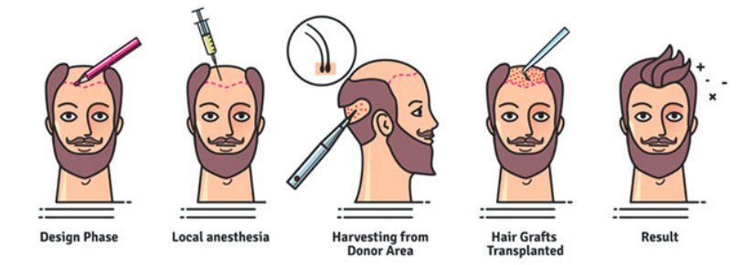 Advanced hair restoration treatment Gurgaon